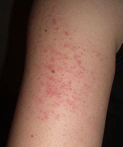 Keratosis - Wikipedia