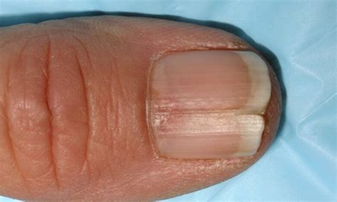 HOW TO REPAIR SPLIT NAILS - Health GadgetsNG