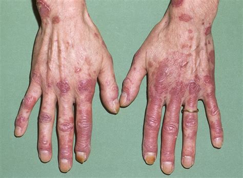 Bệnh nhân lupus ban đỏ phải cấp cứu vì điều này