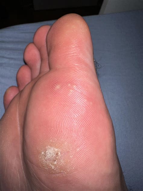 How do I kill them before they grow up? : r/Warts