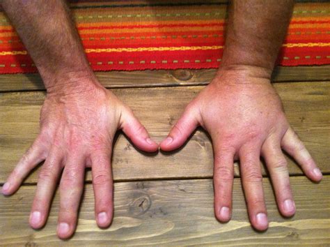 Yellow Jacket Stings: Soothe the Pain with Home Remedies - Hunter Games Magazine