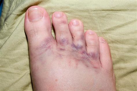 forstuvet fod behandling af forstuvede fodder  praksis