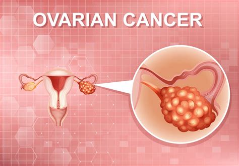 Какви са шансовете за възстановяване от рак на яйчниците — Medconsult.bg