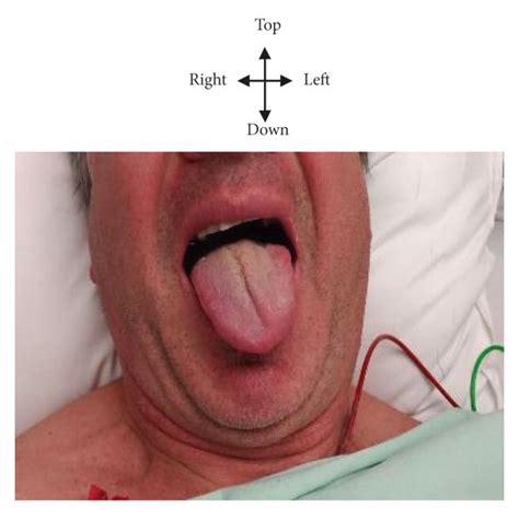 Left ipsilateral deviation of the tongue to protraction (arrow) in Mr ...