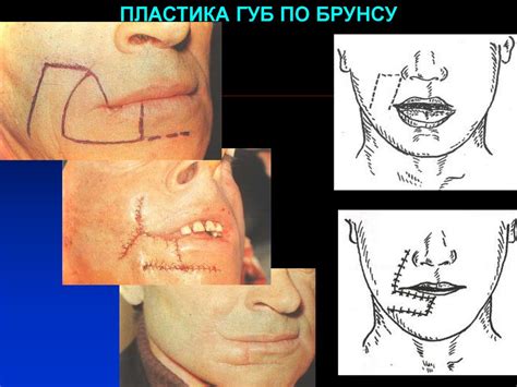 Лоскут на питающей ножке - презентация онлайн