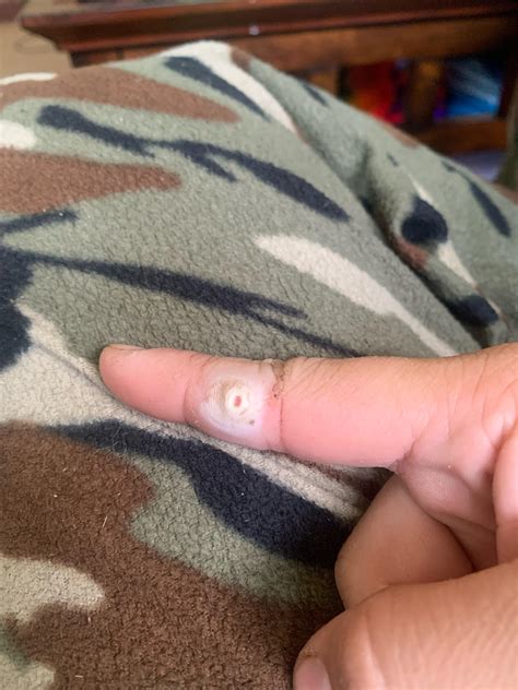 Normal common wart removal? : r/medical