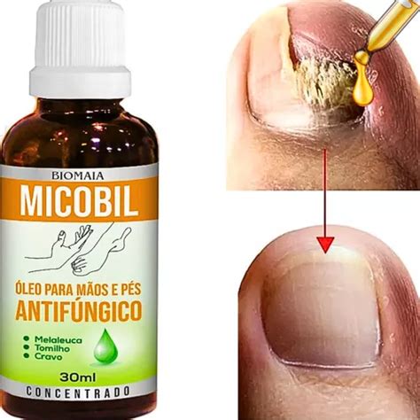 Qual O Melhor Remedio Para Fungos Nas Unhas - Remédio Para Unha Com Fungo Caseiro Natural para pés e mãos Unhas ...