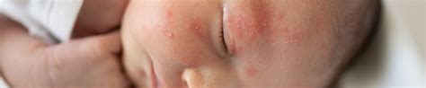 Baby Acne | Parent Survival Guide | ParentMD