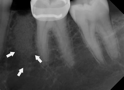 full text dental implant placement  focal osteoporotic bone marrow