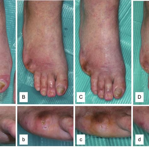 The right foot ulcer prior to spinal cord stimulation. A : Whole view ...
