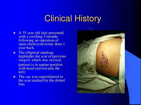 Repair of incisional hernia! A anatomical and technical challenge.