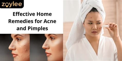 effective pimple home remedies clear acne skin tips