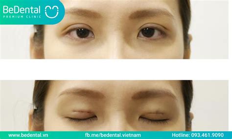 mat  la gi   cach khac phuc mat  nha khoa bedental