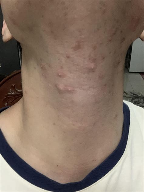 Acne