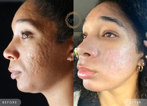TCA Cross - A Powerful Treatment for Acne Scars