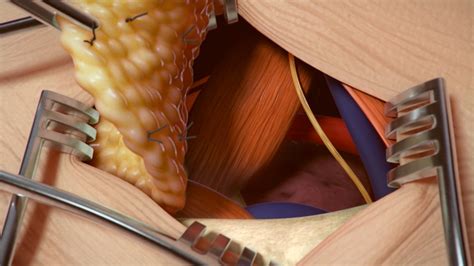 THORACIC OUTLET SYNDROME - XVIVO