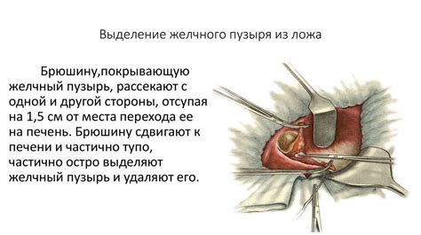 Холецистэктомия. Травма печени - презентация онлайн