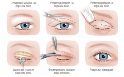 Ксантелазма век: причины появления бляшек, методы лечения и профилактики