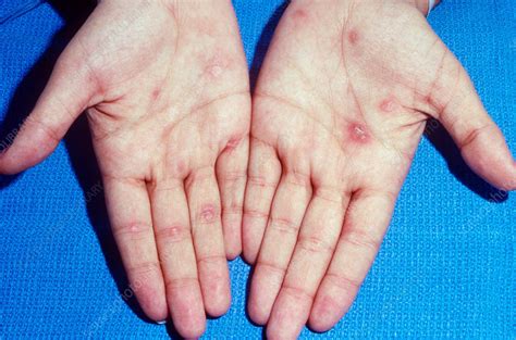 secondary syphilis stock image  science photo library