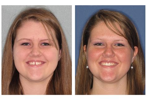 Invisalign® Before and After Photos | Scheier Dental