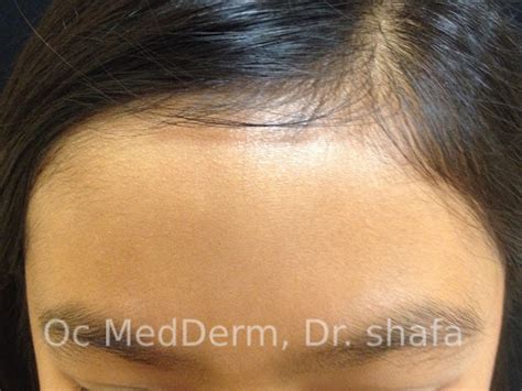 Skin Discoloration Treatment | Irvine & Orange County | OC MedDerm