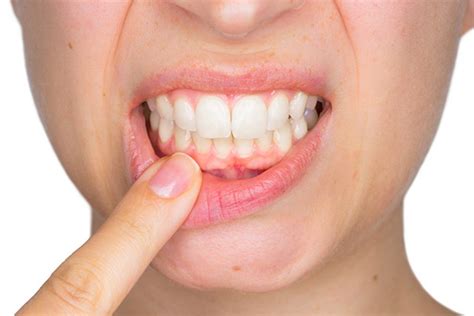 Swollen Gums Treatment - BellevueRX - Bellevue Pharmacy Site