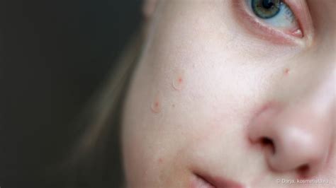 Патчи от прыщей Cosrx Acne Pimple Master Patch | Отзывы покупателей ...