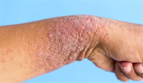 Dermatitis atópica, una enfermedad más allá de la piel