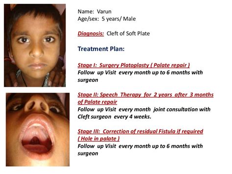 Free Cleft Palate Surgery