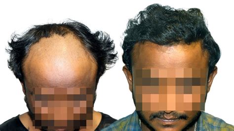 5000 Grafts Hair Transplant Result In Hyderabad - YouTube