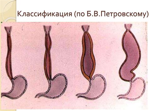 Синдром дисфагии - презентация онлайн