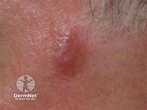 granuloma anular generalizado da face