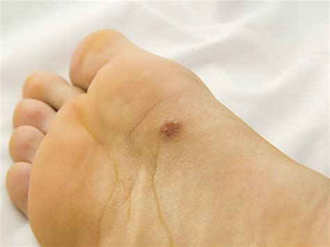 Pictures Of Skin Cancer On Top Of Foot Deals | emergencydentistry.com