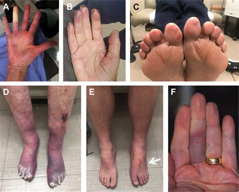 Cold Hands or Feet - Medical Clinics