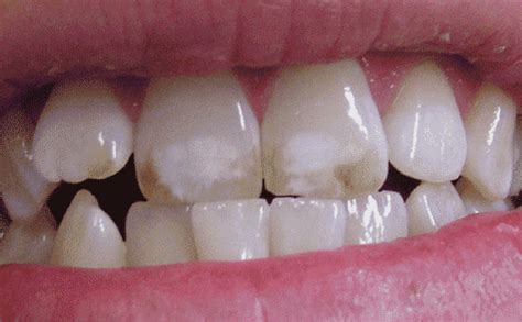 Dental Fluorosis – Symptoms, Causes and Treatment » Locus Dental Care