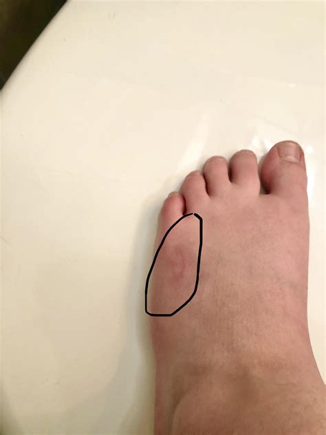 any advice to prevent this bruise I keep getting on my right foot? : r