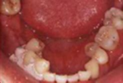 ORTHOLUTION Retromolar pad