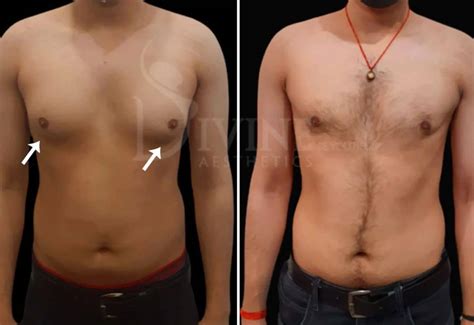 Gynecomastia Surgery Before and After Images | 360° Gyno Result