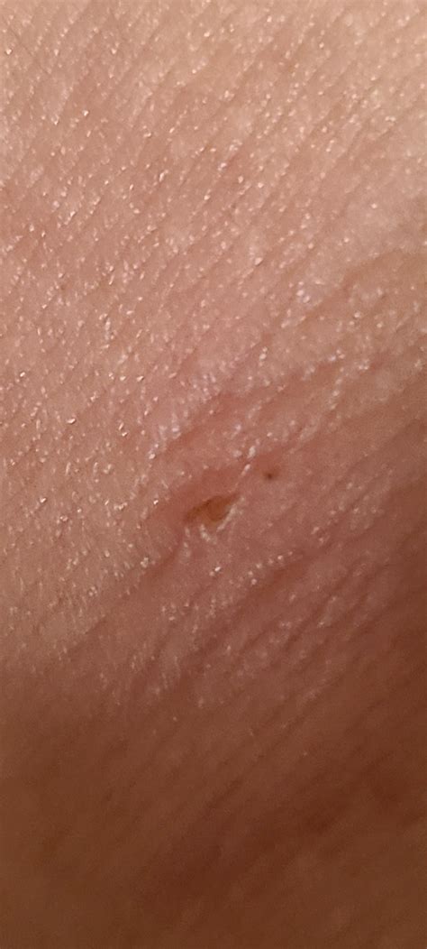 Bitten by a Brown Recluse? : r/BrownRecluseBites