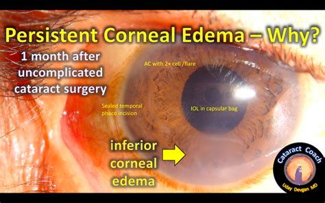 quiz persistent corneal edema  cataract coach