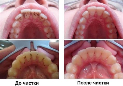 Профессиональная чистка зубов в Тюмени 👍 Цены на проф. гигиену полости ...