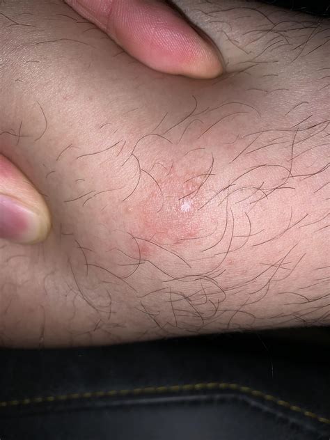 Ringworm Question : r/medical