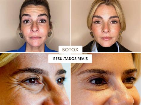 Antes E Depois Do Botox No Rosto - Botox® no rosto: Antes e depois de mulheres que inspiram! - Skin Boutique