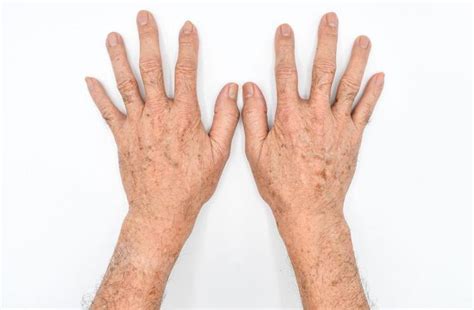 cari tahu penyebab kulit tangan menghitam