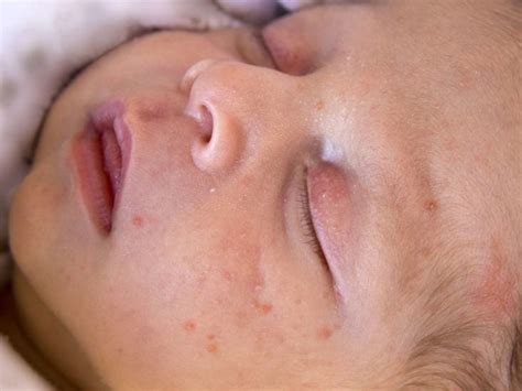 Infantile Acne