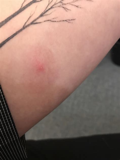 Got this spider bite on my arm. : r/popping