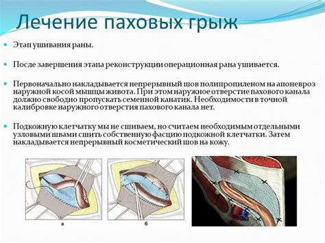 Паховая грыжа – причины, симптомы, лечение, профилактика
