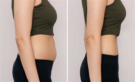 abdomen fat dissolving  aqualyx monaz clinic london