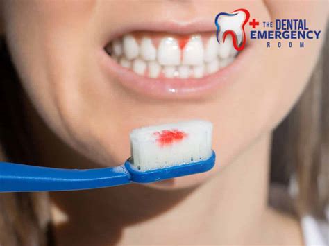 bleeding gums  effective treatments prevention tips