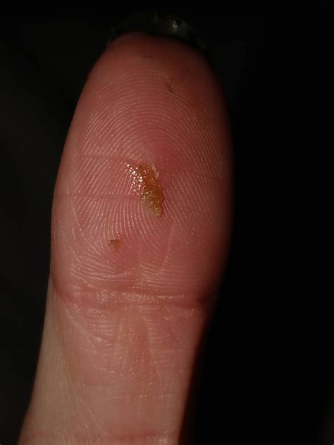 Huge blackhead I just popped from my ear. : r/popping